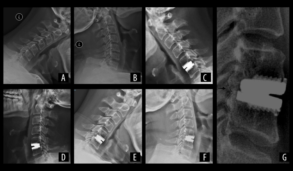 A 51-year-old man with C5/6 Prestige-LP cervical disc arthroplasty. Preoperative flexion and extension roentgenographs indicated that preoperative segmental ROM=4.23° (A, B). Postoperative flexion and extension roentgenographs indicated that postoperative replacement segment ROM=5.9°; the posterior margin of the upper prosthesis-endplate distance was 4.1 mm, and the posterior margin of the lower prosthesis-endplate distance was 2.4 mm (C, D). Postoperative flexion and extension roentgenographs after 36 months indicated that replacement segment ROM=4.39° (E, F), and the postoperative 36-month roentgenograph showed McAfee Grade III HO (G, arrow).