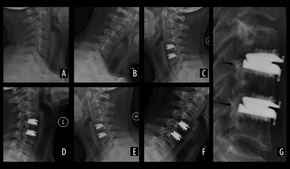 A 52-year-old woman with C4/5 and C5/6 Prestige-LP cervical disc arthroplasty. Preoperative flexion and extension roentgenographs measured the preoperative segmental ROM: C4/5 ROM=6.43°, C5/6 ROM=7.48° (A, B). Postoperative flexion and extension roentgenographs measured the postoperative replacement segment ROM: C4/5 ROM=7.66°, C5/6 ROM=8.07°, posterior margin of the upper prosthesis-endplate distance: C4/5=4.7 mm, C5/6=6.0 mm, posterior margin of the lower prosthesis-endplate distance: C4/5=2.7 mm, C5/6=3.1 mm (C, D). Postoperative flexion and extension roentgenographs after 12 months measured the replacement segment ROM: C4/5 ROM=7.26°, C5/6 ROM=3.76° (E, F), and the postoperative 12-month roentgenograph revealed C4/5 McAfee Grade II HO and C5/6 McAfee Grade III HO (G, arrow).