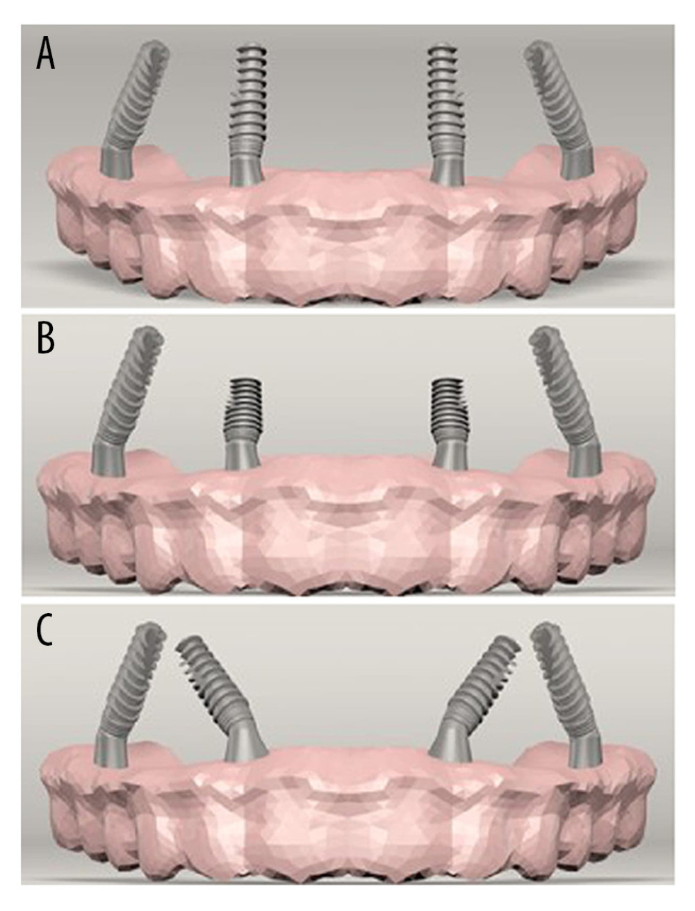 (A) Standard All-on-4 Model (Model 1). (B) All-on-4 Model with short implants (Model 2). (C) M-4 Model (Model 3).