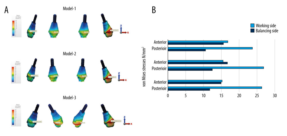 (A) von Misses stress distributions and (B) von Mises stress values (N/mm2) on abutments for Models 1, 2, and 3 in canine-guided occlusion.