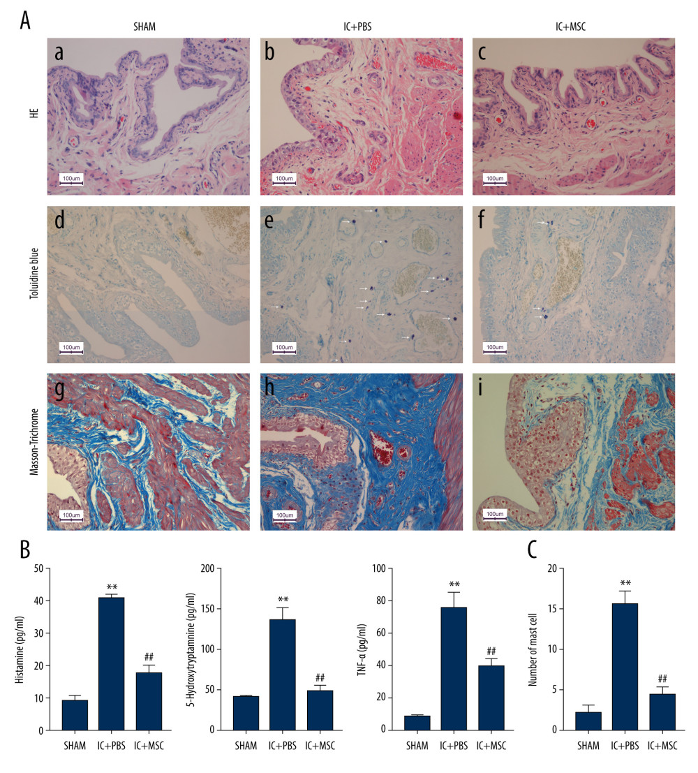Human umbilical cord-derived mesenchymal stem cell (UC-MSC) treatment ameliorated inflammation in the interstitial cystitis (IC)-induced rat model. (A) (a–c): Hematoxylin and eosin staining; (d–f): Toluidine blue staining; (g–i): Masson’s trichrome staining. Hemorrhage, submucosal edema, vascular structure destruction (a–c) were more severe in the IC+PBS group, and recovered better in the IC+MSC group. The mast cell infiltration (white arrows in e and f) could be more easily observed in the IC+PBS group, compared with in the IC+MSC and sham groups. Tissue fibrosis (blue straining in g–i) was significantly decreased below the urothelium in the IC+MSC group (collagenous fiber, 24.52%) compared with in the IC+PBS group (collagenous fiber, 50.19%), but were similar to the sham group (collagenous fiber, 20.33%). Magnification ×200. (B) Comparison of histamine, 5-hydroxytryptamine (5-HT), and TNF-α among the 3 groups in bar charts. (C) Comparison of the number of infiltrating mast cells in the bladder of rats among the 3 groups in bar charts. ** P<0.01 vs sham group; ## P<0.01 vs IC+PBS group.