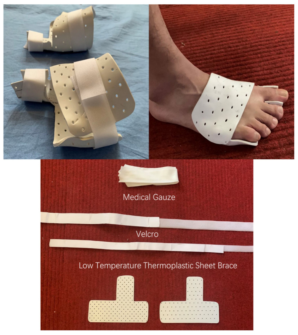 The first metatarsophalangeal joint constraint (FMJC) consists of a low-temperature thermoplastic sheet brace, medical gauze, and Velcro.