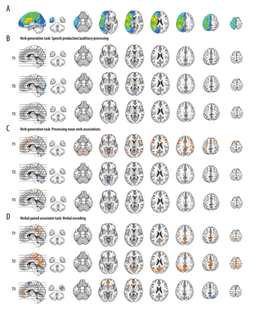 Composite lesion map and functional magnetic resonance imaging (fMRI) activation for the 13 participants. The composite lesion map and fMRI task activation maps at baseline (T1), immediately after treatment (T2) and at 3-month follow-up (T3; n=12) are overlaid onto a standard anatomical brain image in Montreal Neurologic Institute space. For all axial slices, left in the image is left in the brain. (A) The composite lesion map color scale ranges from the minimum (n=1 in blue) to the maximum (n=10 in red) number of participants that show overlap of lesions. (B) Statistical maps illustrating whole-brain fMRI activation patterns during speech production/auditory processing (“say verbs” vs “think verbs”) on the verb generation task are diminished at all 3 time points. Activation clusters are significant at corrected p<0.05 (voxelwise p=0.05, cluster threshold of 2079 mm3). (C) Activation related to processing noun-verb semantic associations on the verb generation task (“say verbs” vs “repeat nouns”) are present in frontal, temporal and parietal regions at T1 with minimal activation at T2 and T3. Activation clusters are significant at corrected p<0.05 (voxelwise p=0.05, cluster threshold of 2079 mm3). (D) Statistical maps illustrating whole-brain fMRI activation patterns during verbal encoding (“generate” vs “read”) on the verbal paired associates task are similar at T1 and T2, and differing at T3. Activations are significant at p<0.05, corrected (voxelwise p=0.05, cluster threshold of 1836 mm3).