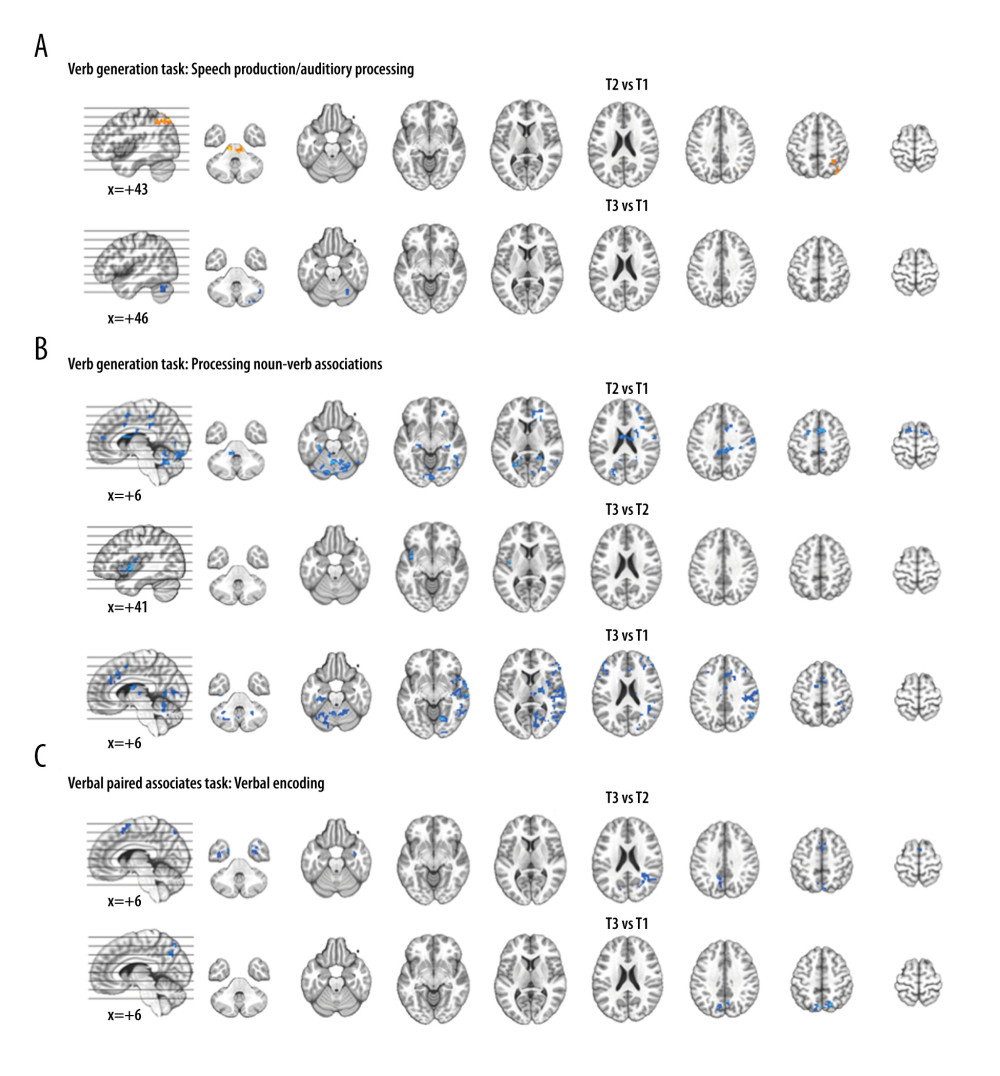 Functional magnetic resonance imaging (fMRI) statistical maps showing changes in activation over time. Paired t-tests reveal differences in fMRI activation between the 3 visits for the verb generation and verbal paired associates tasks. Coordinates of peak activation differences and extent of brain regions are provided in Table 3. Comparisons of immediately post-treatment relative to baseline (T2 vs T1) included 13 participants, while comparisons of 3-month follow-up relative to either immediately post-treatment (T3 vs T2) or to baseline (T3 vs T1) included 12 participants. The fMRI statistical maps are overlaid onto a standard anatomical brain image in Montreal Neurologic Institute space. For all axial slices, left in the image is left in the brain. (A) Regions showing differences in activation for speech production/auditory processing (“say verbs” vs “think verbs”) between T2 and T1 are shown in orange in the right angular gyrus and midbrain. There were also differences in activation between T3 and T1 in the right cerebellum (in blue). Clusters showing differences over time are significant at p<0.05, corrected (voxelwise p=0.05, cluster threshold of 2079 mm3). (B) T1 compared to both T2 and T3 showed differences in activation for processing noun-verb semantic associations (“say verbs” vs “repeat nouns”) as shown in blue in a number of regions including the cerebellum, as well as frontal, temporal, and parietal regions. The only activation difference for T3 relative to T2 is in the left insula (in blue). Activations are significant at p<0.05, corrected (voxelwise p=0.05, cluster threshold of 2079 mm3). (C) The differences in activation for verbal encoding at T3 relative to both T2 and T1 were in visual and parietal regions (in blue). Differences in activation between T3 and T2 also include bilateral temporal pole and midline frontal regions. Activations are significant at p<0.05, corrected (voxelwise p=0.05, cluster threshold of 1836 mm3).
