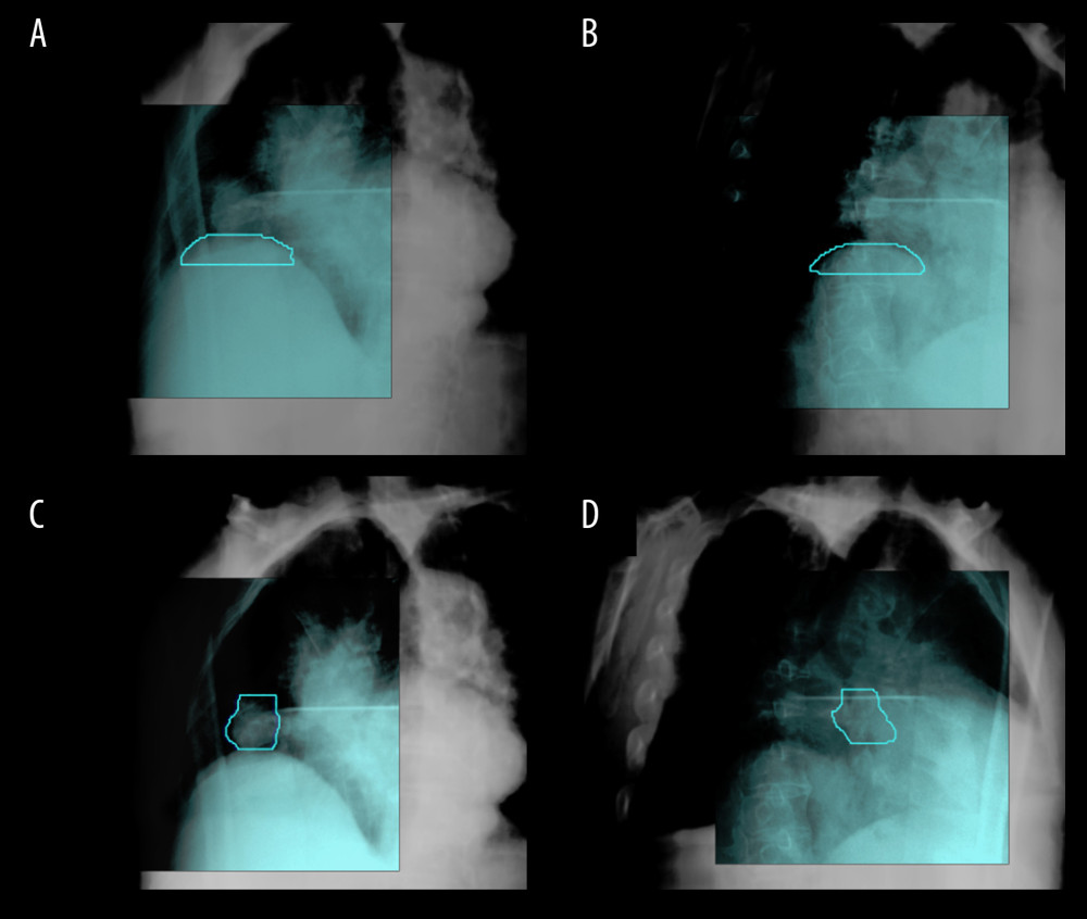 Tracking-guided images using (A, B) diaphragm tracking (DT) and (C, D) Xsight lung tracking (XLT).