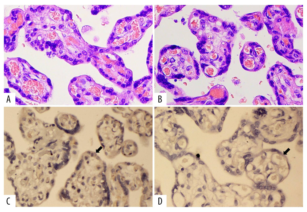 (A) Hematoxylin and eosin (H&E) staining of the control group (HE×400). (B) H&E staining of cholestasis of pregnancy (ICP) group (HE×400). (C) Immunohistochemical staining of inducible nitric oxide synthase (iNOS) in the control group (IHC×400). (D) Immunohistochemical staining of iNOS in ICP group (IHC×400).