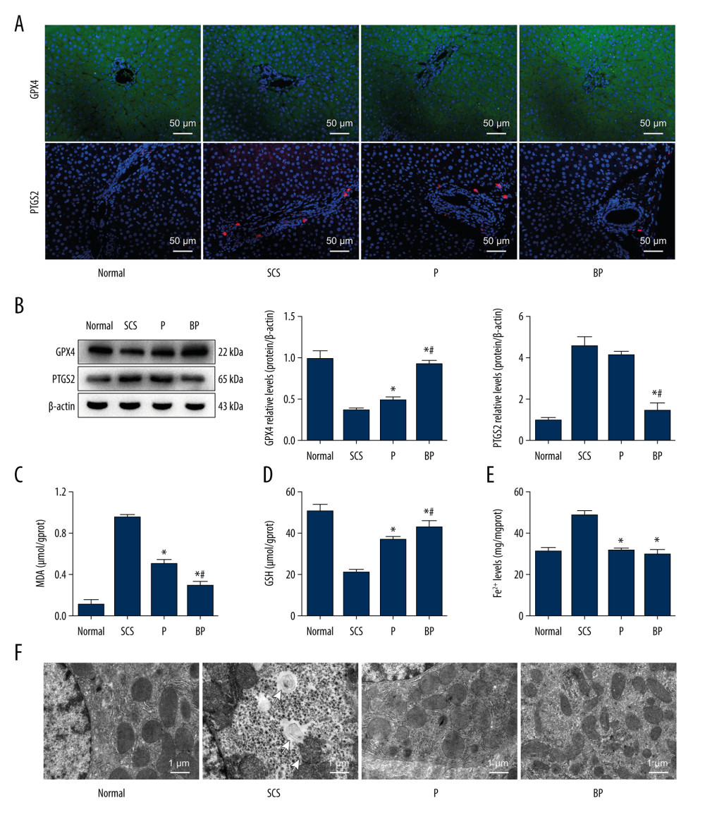 Oxidative stress and ferroptosis of DCD donor liver alleviated by BMMSCs. (A) IF of GPX4 and PTGS2 in hepatic tissues of different groups. GPX4 is shown in green, PTGS2 is shown in red, and the DAPI-stained nuclei are shown in blue. (B) Western blot of GPX4 and PTGS2 in hepatic tissues of different groups. The expression levels of GPX4 in the BP group were significantly higher than those in the P group (P=0.004) and SCS group (P<0.001). The expression levels of PTGS2 in the BP group were significantly lower than those in the P group (P=0.002) and SCS group (P<0.001). (C) MDA in hepatic tissues of different groups (P group vs SCS group, P<0.001; BP group vs SCS group, P<0.001; BP group vs P group, P=0.001). (D) GSH in hepatic tissues of different groups (P group vs SCS group, P 0.001; BP group vs SCS group, P<0.001; BP group vs P group, P=0.132). (E) The levels of Fe2+ release in different groups, which were significantly lower in the P and BP groups than those in the SCS group (P group vs SCS group, P<0.001; BP group vs SCS group, P<0.001; BP group vs P group, P=0.020). (F) The ultrastructure of hepatic tissues in different groups. The mitochondria of hepatocytes in SCS group showed severe edema and vacuolar degeneration, with irreversibly damaged mitochondria, partial mitochondrial necrosis and lysis (shown in white arrow), and disordered mitochondrial crest structure, which mostly disappeared. The mitochondria in the BP group and P group showed almost no swelling or vacuole degeneration, with intact mitochondrial crest structure and less irreversible mitochondrial damage. * P<0.05 vs the SCS group, # P<0.05 vs the P group. DCD – donation after circulatory death; SCS – static cold storage; P – NMP; BP – BMMSCs combined with NMP; NMP – normothermic machine perfusion; BMMSCs – bone marrow mesenchymal stem cells.