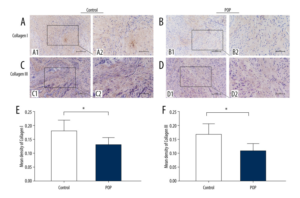 Immunohistochemical staining for collagen I and collagen III in the cardinal ligament. (A–D) Representative images showing that the expression of collagen I and III in the control group was statistically significantly higher than that in the POP group. (E, F) Quantitative analysis. * P<0.05. Magnification: 200× (A1–D1) and 400× (A2–D2). POP – pelvic organ prolapse.