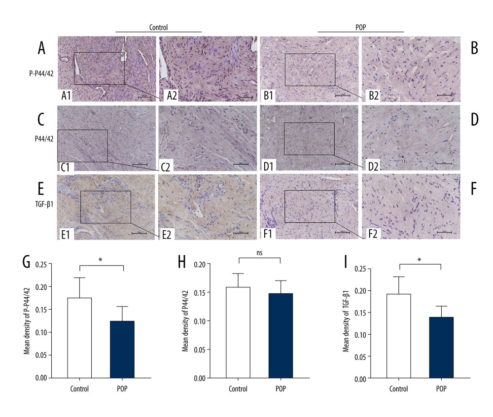 Immunohistochemical staining for TGF-β1, p44/42, and phospho-p44/42 in the cardinal ligament. (A–F) Representative images showing that the expression of TGF-β1 and phospho-p44/42 in the control group was statistically significantly higher than that in the POP group. In contrast, the difference in p44/42 expression between the groups was not significant. (G–I) Quantitative analysis. *P<0.05; ns non-significant. Magnification: 200× (A1–F1) and 400× (A2–F2). POP – pelvic organ prolapse; TGF-β1 – transforming growth factor beta 1; P-P44/42 – phospho-p44/42.