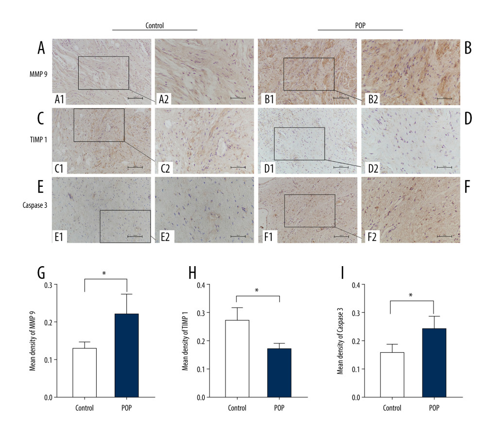 Immunohistochemical staining for MMP9, TIMP1, and caspase 3 in the cardinal ligament. (A–F) Representative images showing that compared with the control group, the expression of MMP9 and caspase 3 was significantly higher and that of TIMP1 was significantly lower in the POP group. Quantitative analysis (G–I). * P<0.05. Magnification: 200× (A1–F1) and 400× (A2–F2). POP – pelvic organ prolapse; TGF-β1 – transforming growth factor beta 1.