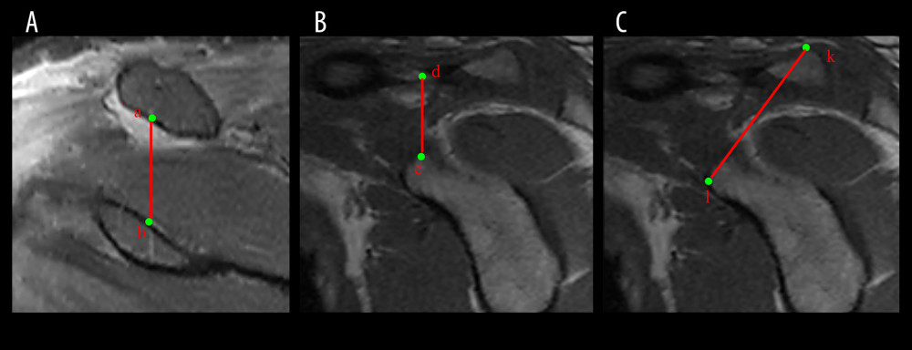 T2-weighted image correlation data for coracoclavicular (CC) ligament magnetic resonance imaging (MRI). (A) Measurement of the length of the CC ligament on T2-weighted MRI. (B) Sagittal coracoclavicular ligament length measurement on T2-weighted MRI. (C) Measurement of the distance from the supraclavicular plane to the subcoracoid plane on T2-weighted MRI. Point a: The central point of the CC ligament at the clavicular attachment. Point b: The CC ligament at the center of the CC attachment. Point d: The CC ligament at the center of the clavicular attachment. Point e: The CC ligament at the coracoid attachment point. Point k: The point of the supraclavicular plane through the CC ligament. Point l: The point of the subcoracoid plane through the CC ligament the length of the CC ligament. ab: The length of the CC ligament in the coronal plane. de: The length of the CC ligament in the sagittal plane. kl: The distance between the supraclavicular plane of the CC ligament and the subcoracoid process plane.