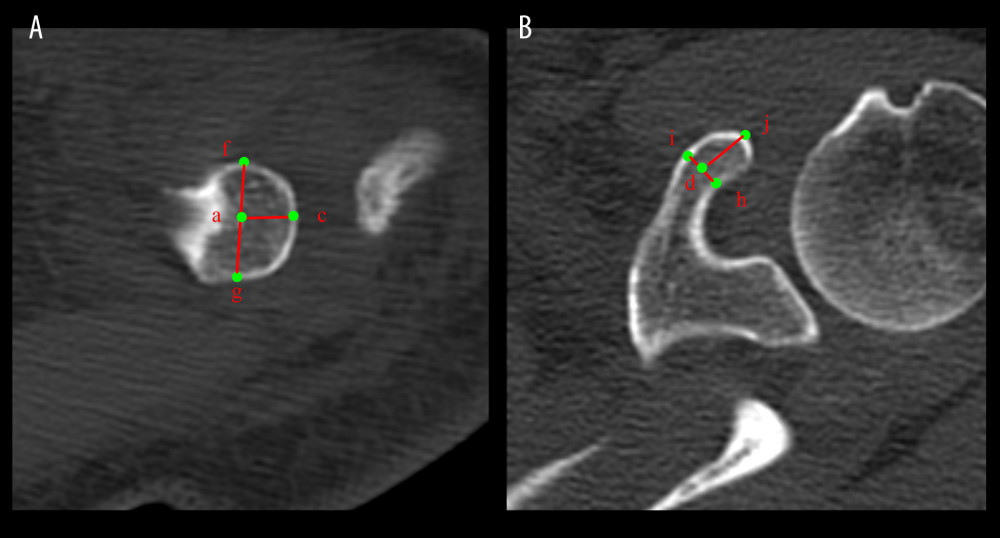 Image correlation data for computed tomography of the coracoclavicular (CC) ligament. (A) Subclavian observation. (B) superior coracoid process observation. Point a: The center of the CC ligament at the clavicular attachment. Point c: The farthest point at the acromion end of the clavicle. Point d: The point of the CC ligament at the center of the clavicular attachment. Point f: The point of the CC ligament at the anterior edge of the clavicular attachment. Point g: The posterior margin of the CC ligament at the clavicle attachment. Point h: The anterior edge of the CC ligament attached to the coracoid process. Point i: The posterior margin of the CC ligament attached to the coracoid process. Point j: Apical apex of the coracoid process. ac: Distance from the center point of the CC ligament at the supraclavicular attachment to the acromioclavicular joint. fg: The maximum diameter of the CC ligament at the anterior and posterior margin of the clavicle attachment. hi: The largest diameter of the CC ligament at the anterior and posterior edge of the coracoid process attachment. dj: The length of the CC ligament from the center point of the coracoid process attachment to the coracoid process tip.