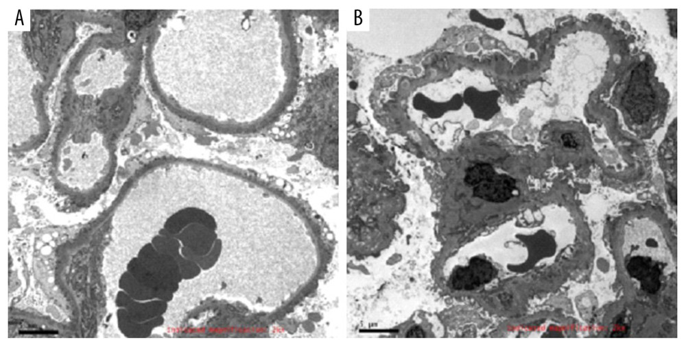 Subtypes of idiopathic membranous nephropathy. (A) Homogeneous type (original magnification ×2000); (B) Heterogeneous type (original magnification ×2000).