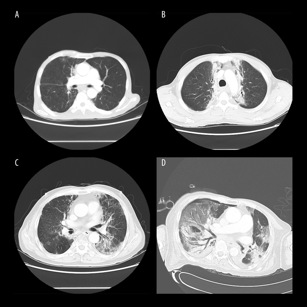 Computed tomography (CT) manifestations of radiation pneumonitis (RP). (A) CT manifestations of grade 1 RP. (B) CT manifestations of grade 2 RP. (C) CT manifestations of grade 3 RP. (D) CT manifestations of grade 4 RP.