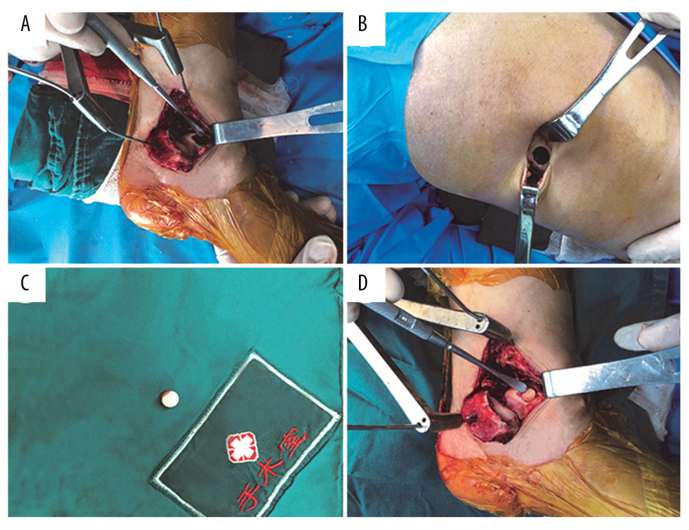 Surgical process. Medial malleolar osteotomy for exposure of posteromedial OCD talar lesion, cleanup subchondral cysts (A), the lesion size was 160 mm2. Lateral knee arthrotomy exposing the trochlear border of the lateral femoral condyle after removal of the osteochondral plug (B). Removal of the osteochondral plug (C). The plug size was 155 mm2. We implanted the osteochondral plug into the talar lesion, and osteochondral plug surface is flush with the talar articular cartilage (D).