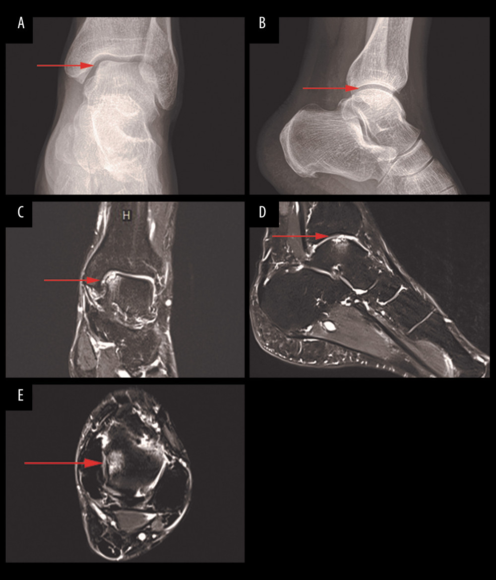 Preoperative X-ray and MRI showing talar cartilage damage. Anteroposterior (A) and lateral (B) ankle radiograph of the ankle. The radiograph demonstrated an incomplete articular surface (arrow). Coronal position (C), sagittal position (D), and transection (E) ankle MRI of the ankle demonstrated osteochondral lesion on the medial talar dome (arrow).