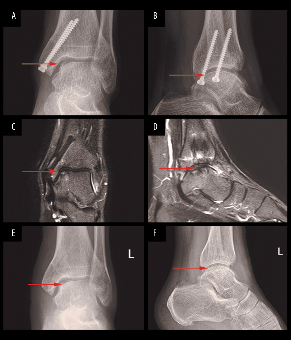 Postoperative X-ray and 24-month follow-up MRI and X-ray. Anteroposterior (A) and lateral (B) ankle radiographs of the ankle 24 months after OATS procedure for an osteochondral lesion of the medial talus (arrow). The radiographs demonstrated an almost healed osteotomy and intact graft. At the same time, MRI of the ankle Coronal position (C), sagittal position (D) 24 months after OATS procedure for an osteochondral lesion of the medial talus (arrow), and the edema had almost disappeared. The anteroposterior (E) and lateral (F) X-ray images of ankle joint after internal fixation was taken out.