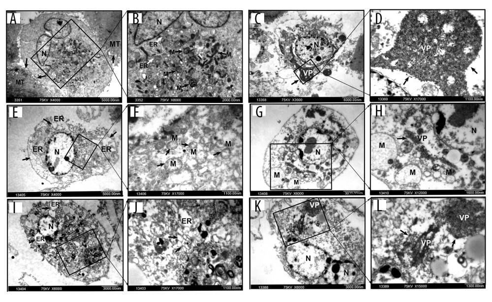Electron microscopy of ultramicroscopic structure changes in 5 cell lines and HPTEC infected with BTV-10 72 hours after infection. HPTECs clearly show an unchanged ultramicroscopic structure compared to the untreated cells: microvilli (MT, arrows), chondriosome (M, arrows), rough endoplasmic reticulum (ER, arrows), nucleus (N) (A ×4000, B ×8000). Viral particles (VP) were observed in all the RCC cell lines, but not in the HPTECs (arrows) (B, C ×8000, D ×13000, G ×6000, H ×12000, K ×6000, L ×15000). Electron microscopy showed chromatin condensation along the periphery of the nucleus (C, E ×4000, G, I ×6000, K), expansion of the rough endoplasmic reticulum (arrows) (I, J ×17 000), decrease of mitochondrial matrix density, and balloon-like swelling (F ×17 000, G, H) in RCC cell lines. (A, B). HPTEC, (C, D). ACHN, (E, F). CAKI-1, (G, H). OR-SC-2, (I, J). 786-0, (K, L). A498.
