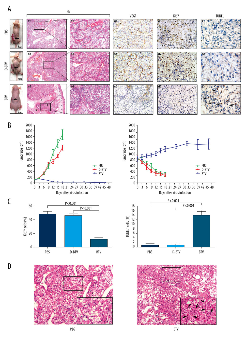 BTVs exert antitumor effects in a renal cancer OS-RC-2 xenograft mouse model. (A) Representative tumor sections from treated mice were harvested after treatment and analyzed by H&E (×40 and×100), cell proliferation (Ki67 ×400), apoptosis (TUNEL ×1000), or angiogenesis (VEGF ×200), by immunohistochemistry. The H&E staining shows that the tumor tissue had disintegrated into smaller components. T – tumor tissue, S – tumor stroma. Sinusoid-like blood vessels were occlusive, degenerated, or absent entirely. The VEGF staining showed less immunoreactivity in BTV-treated tumors than in control groups. (B) Tumor volume (mm3) was measured and the data are presented as mean±SD. Body weight was monitored continuously, and the data shown represent the mean±SD. (C) Quantification of mitotic index (left), and apoptosis (right). Labeled cells were counted in an average of 6 high-power fields. Data represent means±SEM. (D) H&E staining also revealed apoptotic-type cells, such as condensed nuclei and cytoplasm (arrow), in BTV-treated tumors.