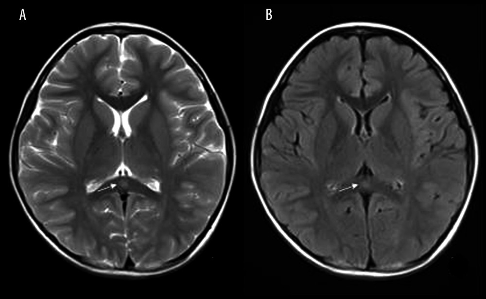Mild Encephalopathy with a Reversible Splenial (MERS) lesion: Fever 1 day, with 2 seizures. Axial T2WI (A) and T2WI-FLAIR (B) of MRI shows that the small piece of bright signal (arrow) in splenium of corpus callosum; no abnormality was found in the rest of the parenchyma.