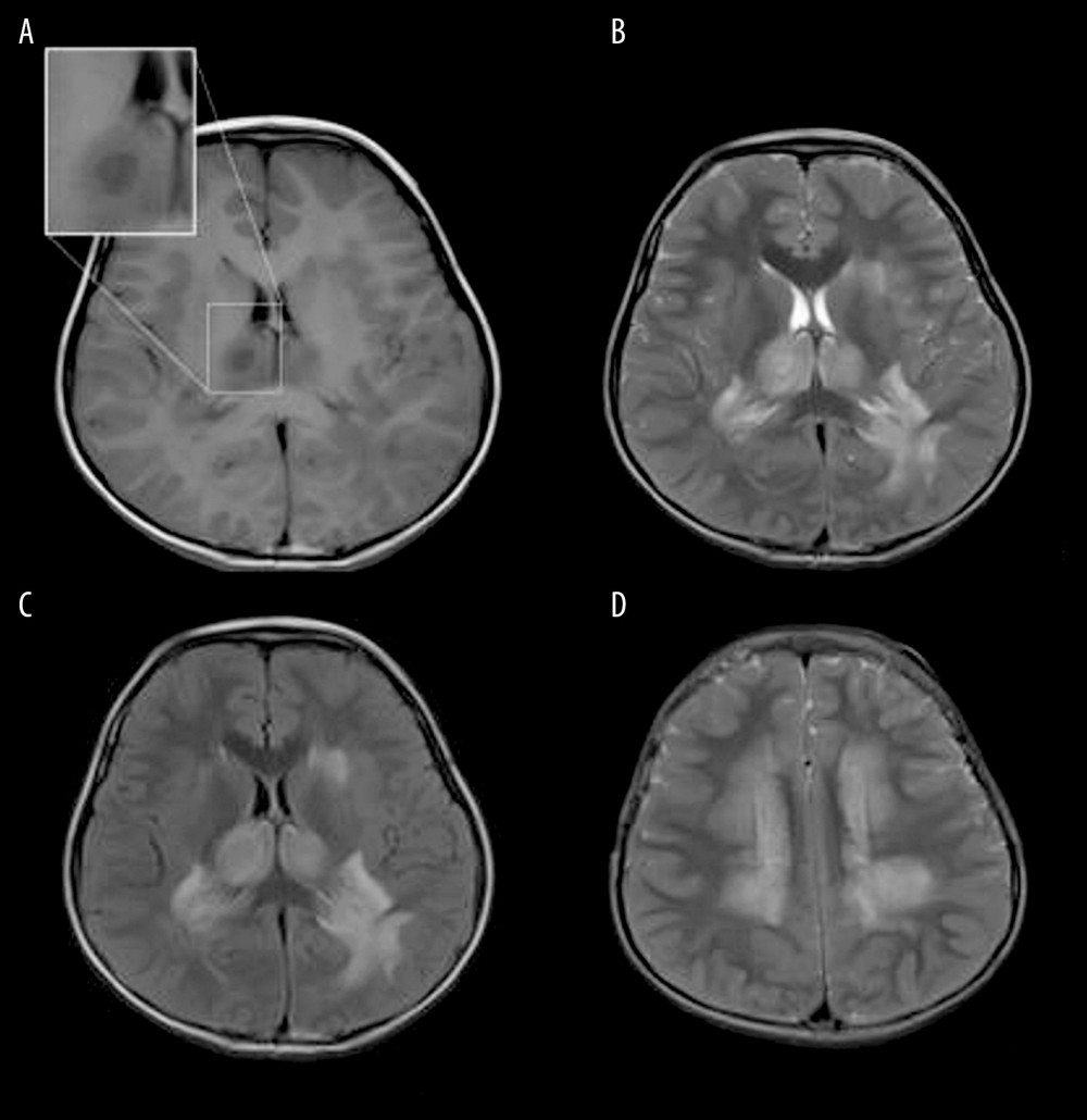 Acute Necrotizing Encephalitis of Childhood (ANE). Fever 1 day, convulsion 3 times. Symmetrical and multifocal involvement were showed in bilateral thalamus and paraventricular (A. T1WI, B. T2WI, C. T2WI-FLAIR) and radial coronal hemisovale center (D) white matter with bilateral thalamus swollen.