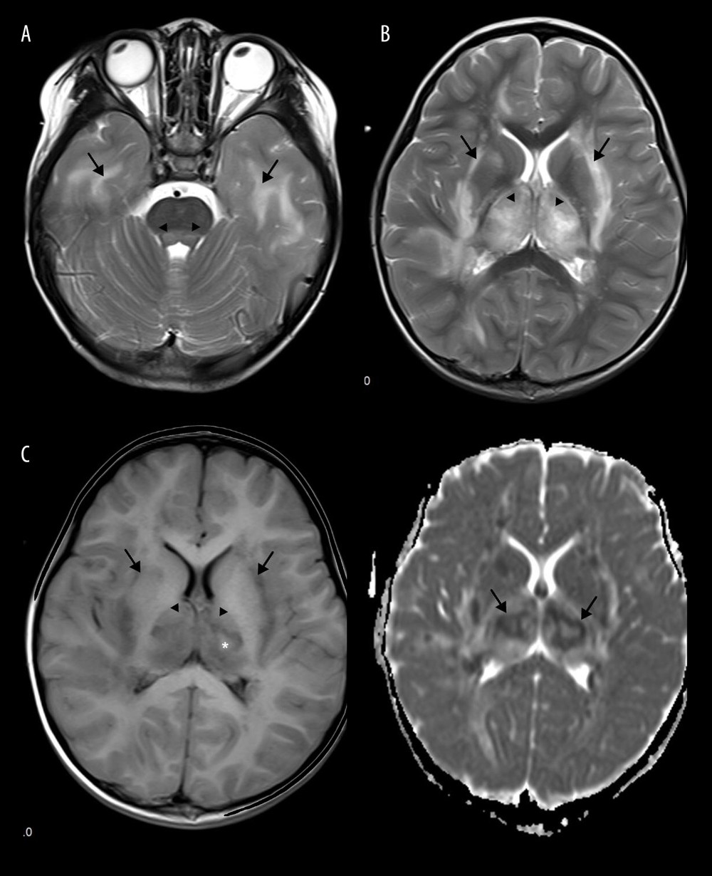 Emesia, febris for 5 days, followed by coma, with throat wrap for influenza type B positive (A–C). (A) Axial T2WI MRI showed mildly higher focal signal intensity in the dorsal aspect of pons (arrow), and mildly higher patchy signal intensity in white matter at bilateral temporal lobe (arrow). (B) Axal T2WI MRI indicated symmetric swelling and higher signal intensity in bilateral thalami (arrow), and white matter in external capsule was involved. (C) Axial T1WI MRI indicated mildly lower signal intensity in bilateral thalami (arrow) with slightly higher signal intensity in center (*), involvement of white matter in external capsule (*) was visible; axial ADC map showed more detailed 3-layer structure of bilateral thalami in ANE (arrow).