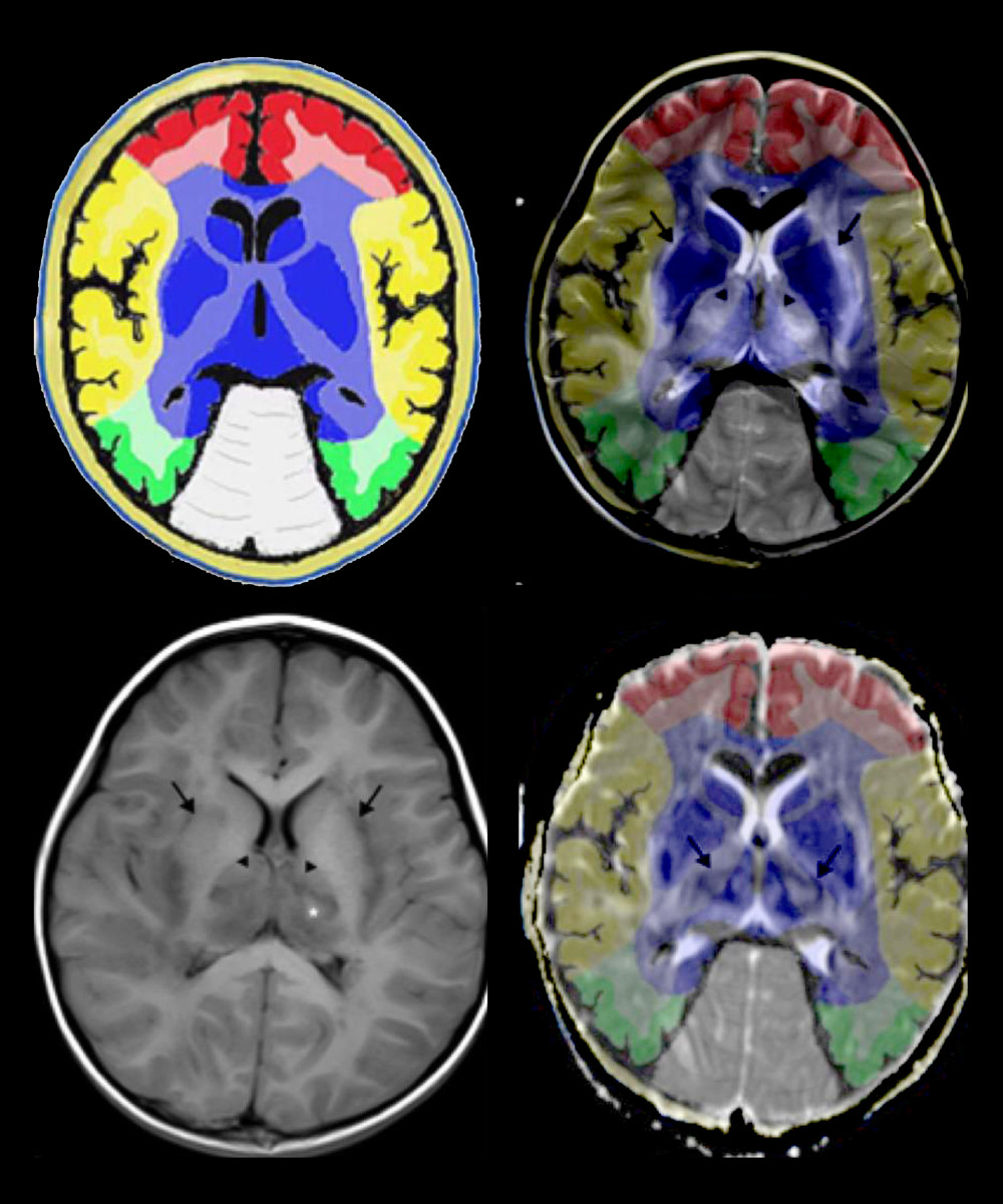 Comparison of brain vascular innervation area and MRI of IANE.