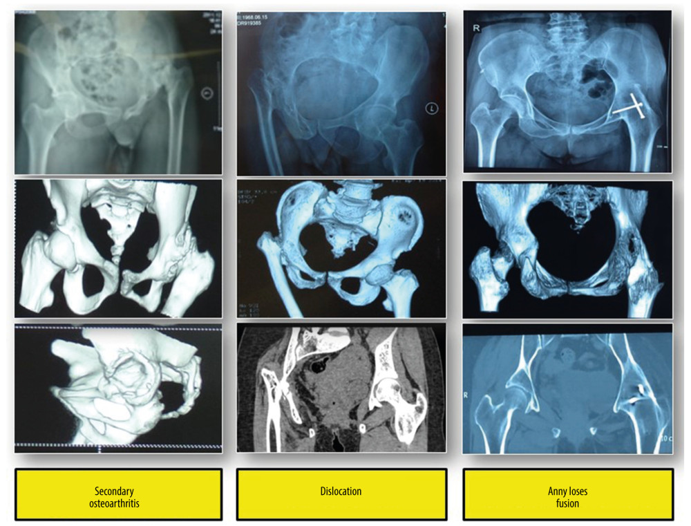 Adult patients with sequelae of childhood hip infection on the basis of anatomic classification.