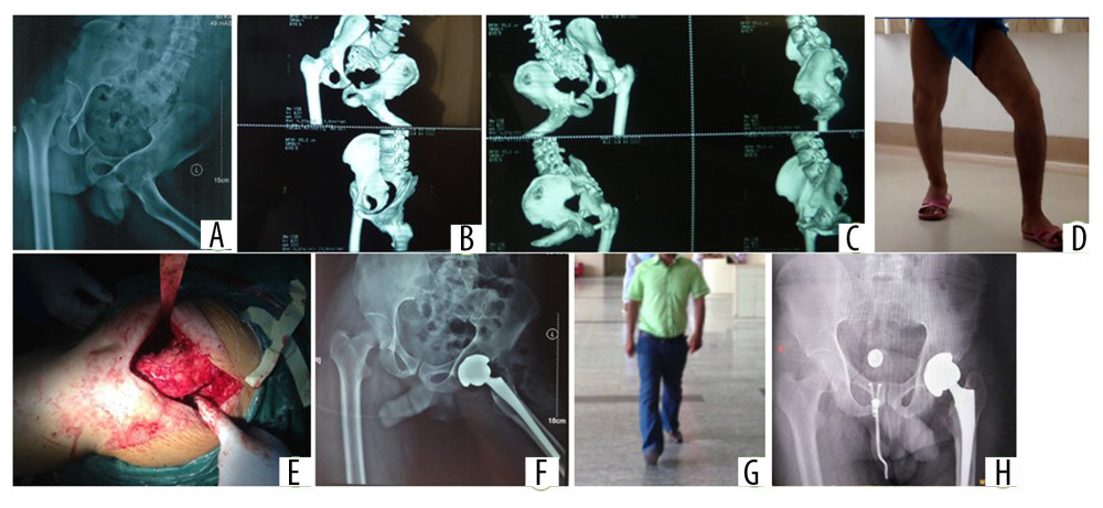 A 28-year-old man with left sequelae of childhood hip infection (ankyloses fusion type). (A–C) Preoperative X-ray and CT 3D reconstruction show the hip joint has abduction-extorsion deformity and ankylosis. (D) Preoperative gait, he cannot even walk normally. (E) Intraoperatively, we used the strategy of “single incision, double approaches”, posterolateral incision, femoral neck osteotomy by anterior and posterior approach. (F) Postoperative X-ray. The hip was reconstructed at the level of the anatomic hip center with cementless acetabular. (G) Normal gait was restored and the hip deformity returned to normal 1 year after the operation. (H) Seven years after the surgery, the femoral prosthesis is stable in a satisfactory position and the position of the acetabular prosthesis was also stable and acceptable.