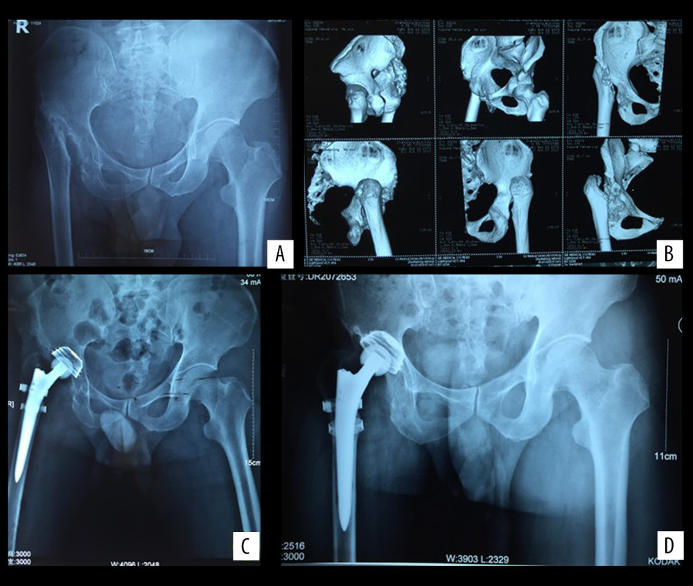 A 39-year-old man with left sequelae of childhood hip infection (dislocation type). (A, B) Preoperative X-ray and CT 3D reconstruction show the high dislocation hip deformity and the narrow femoral canal deformity. (C) Postoperative X-ray. The cup was placed in the true position of the acetabulum and 2 cerclage bands around the femur were used to prevent intraoperative fractures. (D) Four years after the surgery, the femoral and acetabulum prosthesis are stable in satisfactory position.