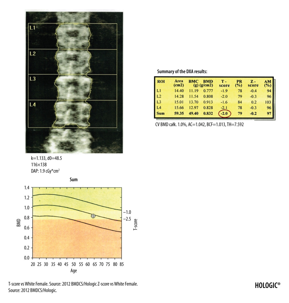 DXA examination of the lumbar spine. At the bottom of the picture is visible the borderline L5/S1, at the top the last pair of ribs connected to the Th12 vertebra. The presented image of the lumbar spine is not suitable for diagnostic objectives, but it is used to identify the ROI in the lumbar spine (vertebral bodies from L1 to L4). The diagnostic result is the T-score parameter estimated for the entire examined ROI area (circled in red). If, due to degenerative changes or artifacts, all 4 lumbar vertebrae cannot be used for analysis, 3 vertebrae should be used. The result of examination is reliable if at least 2 vertebrae are suitable for analysis.