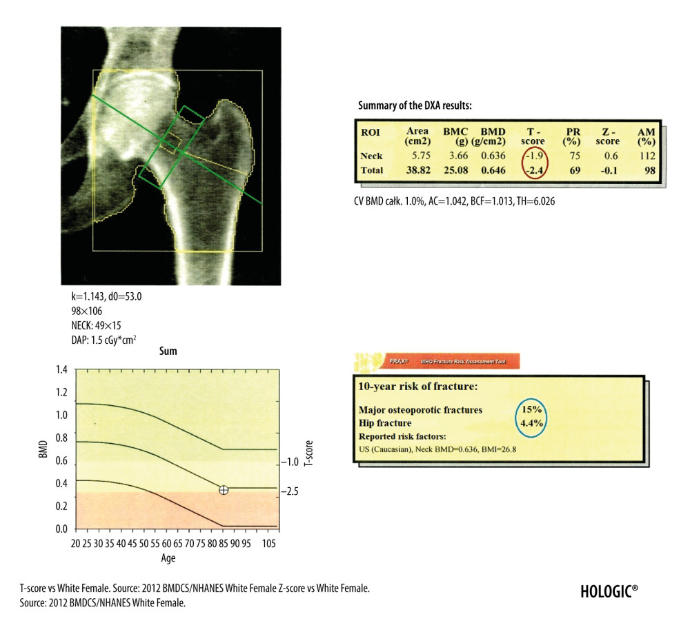 DXA examination of the hip. The diagnostic result is the T-score parameter estimated for the femoral neck (the upper value in the red circle) and for the total proximal femur (the lower value in the red circle). The ROI of the femoral neck (marked as green frame) should be perpendicular to the femoral neck, should not include the greater trochanter and the ischial bone, but should include soft tissues on both sides of the femoral neck. The midline (marked as green line) should cover the long axis of the femoral neck. In the blue circle is marked the FRAX for major osteoporotic fracture (upper value) and FRAX for hip fracture (lower value).
