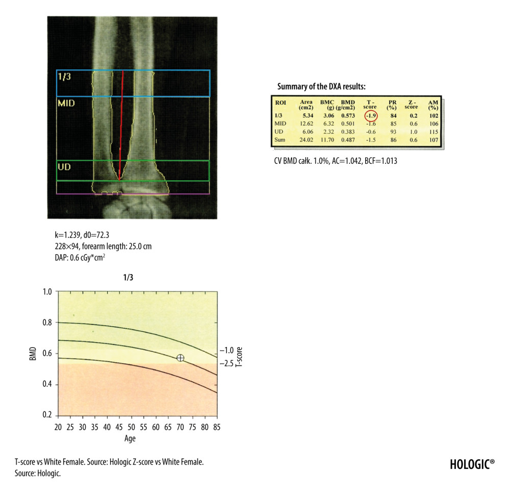 The DXA examination of the right forearm. The diagnostic result is the T-score parameter estimated for the 1/3 ROI of nondominant forearm (blue frame). The reference line (marked in purple) should be positioned at the distal end of the styloid process of the ulna, the radius plate should be located outside the ROI UD (green frame), and a vertical line crossing the middle of the 1/3, MID, and UD ROI (marked in red) should cut the airspace between the radius and ulna.