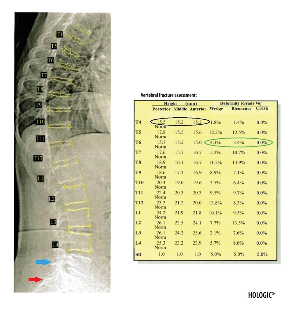 Result of the VFA examination in the thoracic and lumbar spine. The table shows individual vertebral heights in millimeters (marked in the black circle – the posterior, middle and anterior height, respectively, in order from the left) and the degree of deformation (%) of vertebral bodies (marked in the green circle – the wedge, biconcave and crush deformation, respectively, in order from the left). The red arrow indicates the position of the sacrum and the blue arrow the position of the L5 vertebra. Clear visualization of the sacrum and vertebra L5 is necessary for identification of examined vertebrae.