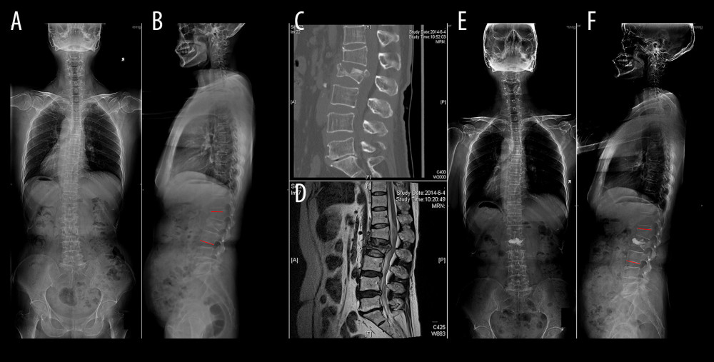 The patient was a 61-year-old woman with an L2 compression fracture. Only percutaneous kyphoplasty was performed, and the postoperative radiological outcome was observed. The red line through B and F indicates the local kyphotic angle. (A, B) Preoperative full spinal radiographs showing the L2 vertebral compression fracture. (C, D) Preoperative CT and MRI showing the L2 vertebral compression fracture with obvious spinal canal encroachment. (E, F) Postoperative full spinal radiographs showing bone cement permeating the L2 vertebrae.