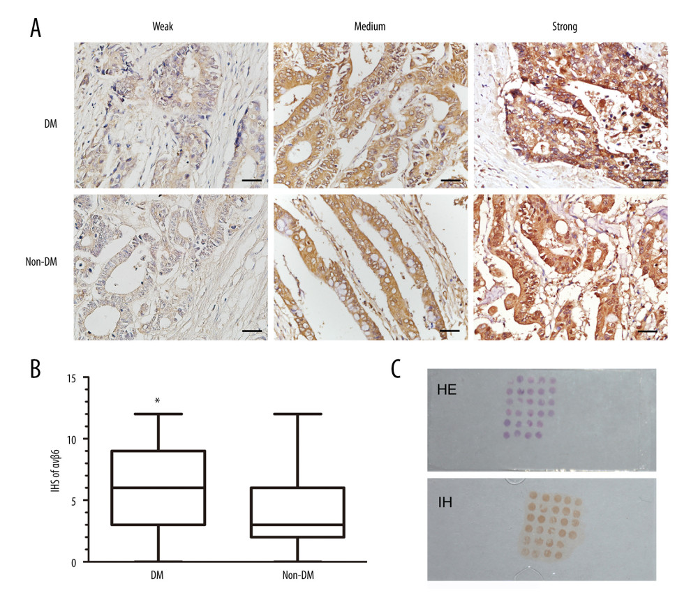 Immunohistochemical expression of αvβ6 in DM group and non-DM group. (A) Immunostaining of αvβ6 in representative colorectal cancer tissues of the DM group and non-DM group (×40). Bar=20 μm. (B) Box-and-whisker graph demonstrated that immunohistochemistry scores (IHS) of αvβ6 in the DM group were significantly higher than in the non-DM group. (C) Representative hematoxylin-eosin (HE) and immunohistochemical (IH) image of tissue microarray. * P<0.01 vs non-DM group.