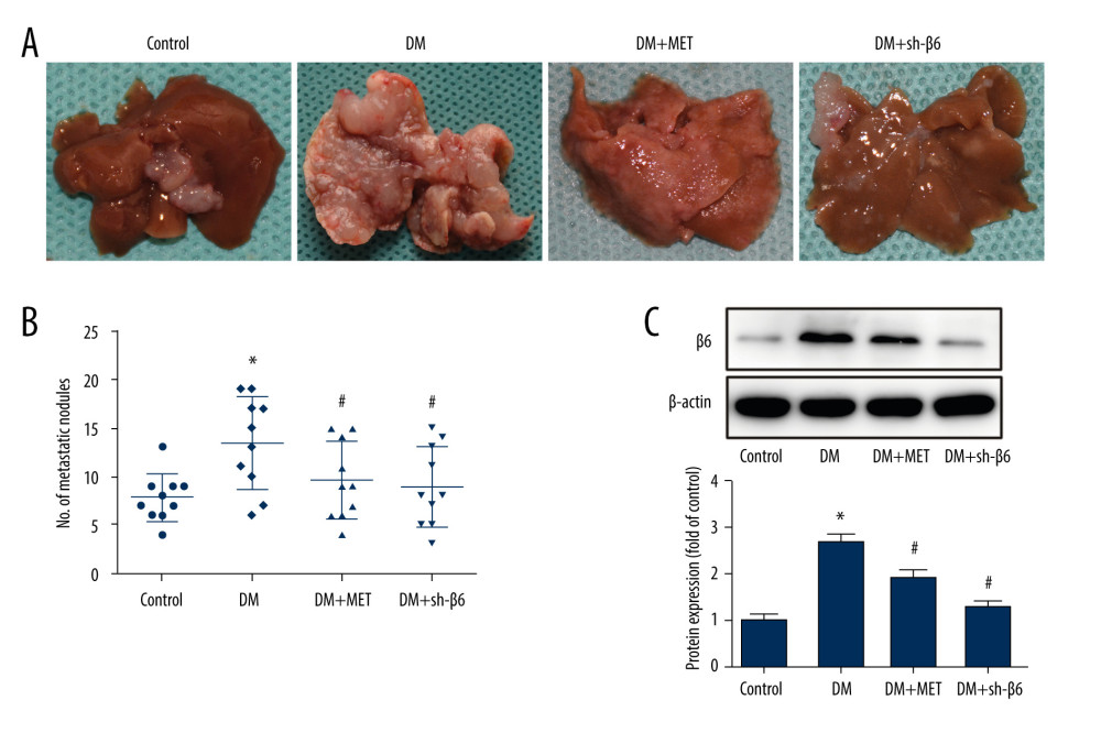 Diabetes promoted liver metastasis through integrin αvβ6 in the mouse model. (A) Liver metastasis was induced by intrasplenic injection of CT26 cells. (B) The number of liver metastatic nodules in each group is shown. (C) Protein expression of β6 was detected by western blot. * P<0.05 vs control. # P<0.05 vs DM. DM – diabetic mice; DM+MET – diabetic mice treated with oral administration of metformin; DM+sh-β6 – diabetic mice treated by injection of β6 shRNA.