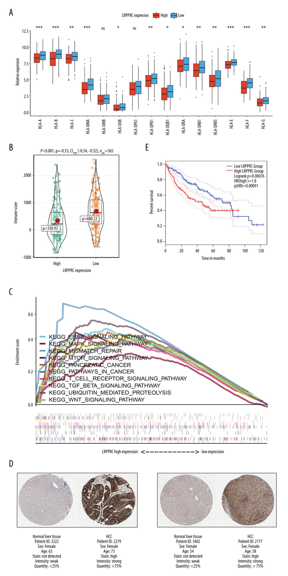 Potential roles of the LRPPRC N6-methyladenosine (m6A) modulator in immune microenvironment formation and hepatocarcinogenesis. (A) Differences in human leukocyte antigen molecule expression between LRPPRC high-expression and low-expression groups. (B) Differences in immune components between LRPPRC high-expression and low-expression groups. (C) Gene set enrichment analysis reveals the significant Kyoto Encyclopedia of Genes and Genomes pathways enriched in patients with high LRPPRC expression. (D) Representative LRPPRC immunohistochemical staining in normal liver tissues and those from patients with hepatocellular carcinoma in the Human Protein Atlas database. (E) Kaplan-Meier curve survival analyses for The Cancer Genome Atlas cohort patients with high and low LRPPRC expression. R (version 3.6.1) software was used to create the pictures.