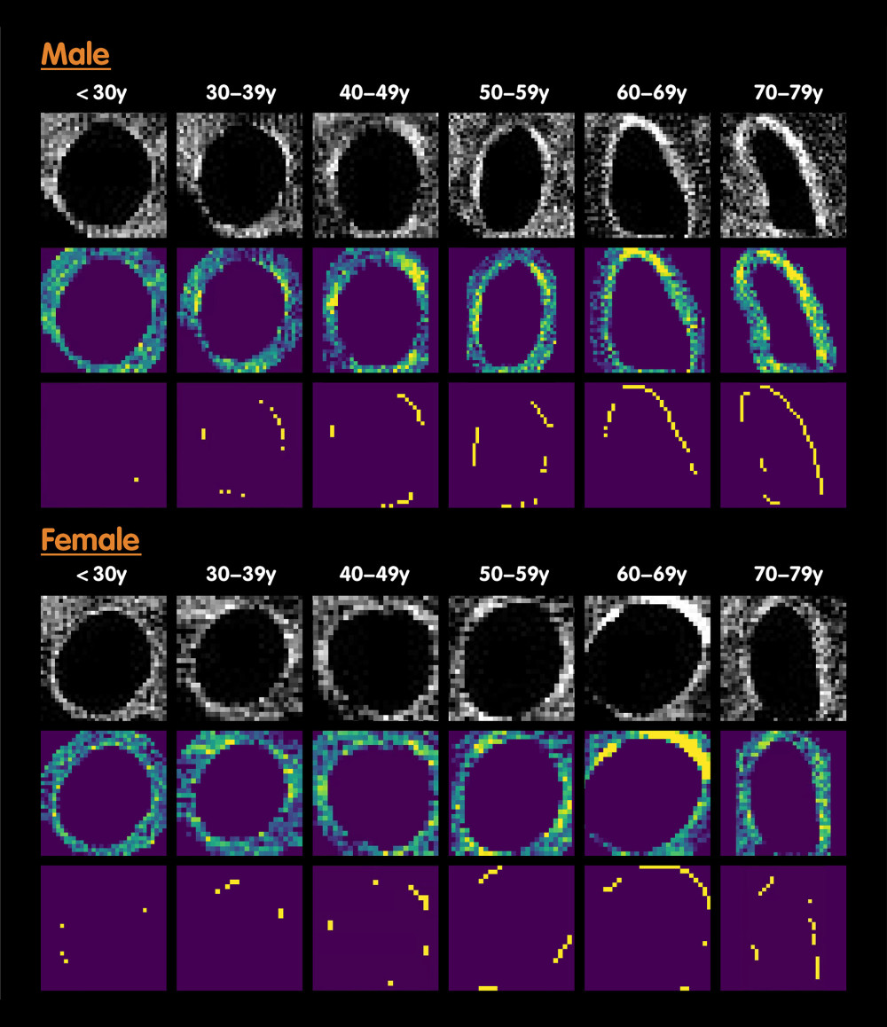 Representative CT images of tracheae from the males and the females in different age groups. The first column, the original image; the second column, the pseudo-color images; the third column, the extracted yellow lines that represent calcification areas.