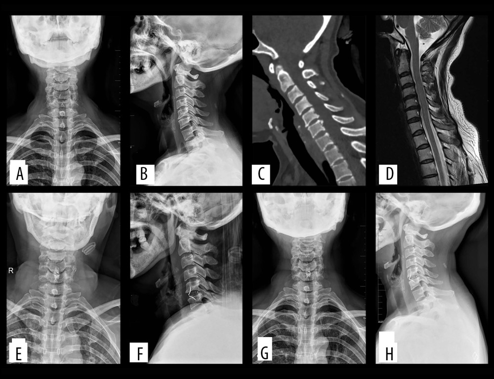 (A–D) Preoperatively, cervical degeneration, hyperosteogeny, C5–6 cervical disc compresses the spinal cord. (E, F) Two days after surgery, X-ray images revealed appropriate C5–6 cervical discectomy and proper positioning of the ROI-C interbody fusion cage. (G, H) One-year after surgery, X-ray imaging revealed appropriate C5–6 cervical fusion and proper positioning of the ROI-C interbody fusion cage. (C – cervical vertebra).
