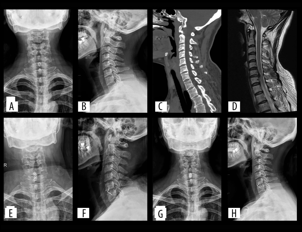 (A–D) Preoperatively, cervical degeneration, hyperosteogeny, C6–7 cervical disc compresses the spinal cord. (E, F) Two days after surgery, X-ray images revealed appropriate C6–7 cervical discectomy and proper positioning of the ROI-C interbody fusion cage. (G, H) One-year after surgery, X-ray imaging revealed appropriate C6–7 cervical fusion and proper positioning of the ROI-C interbody fusion cage.