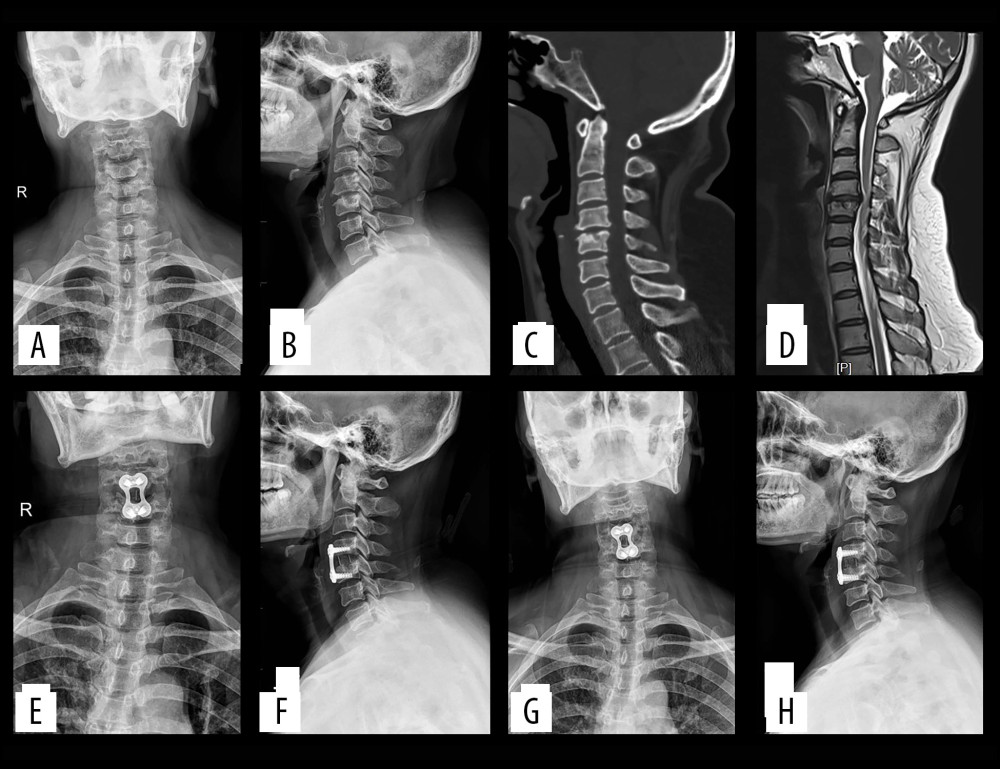 (A–D) Preoperatively, cervical degeneration, hyperosteogeny, C4–5 cervical disc compresses the spinal cord. (E, F) Two days after surgery, X-ray imaging revealed appropriate C4–5 cervical discectomy and proper positioning of the titanium mesh and plate; (G, H) One-year after surgery, X-ray imaging revealed appropriate C4–5 cervical fusion and proper positioning of the titanium mesh and plate.
