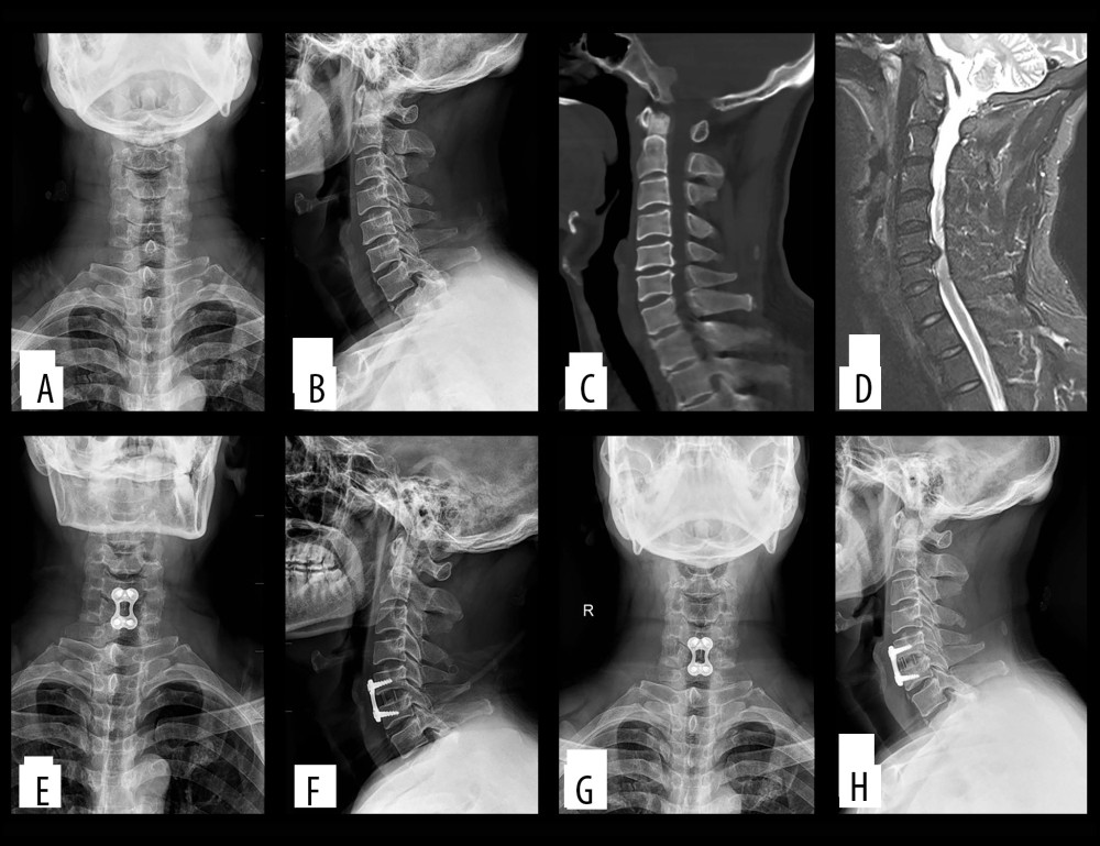(A–D) Preoperatively, cervical degeneration, hyperosteogeny, C5–6 c cervical disc compresses the spinal cord. (E, F) Two days after surgery, X-ray imaging revealed appropriate C5–6 cervical discectomy and proper positioning of the titanium mesh and plate; (G, H) One-year after surgery, X-ray imaging revealed appropriate C5–6 cervical fusion and proper positioning of the titanium mesh and plate.