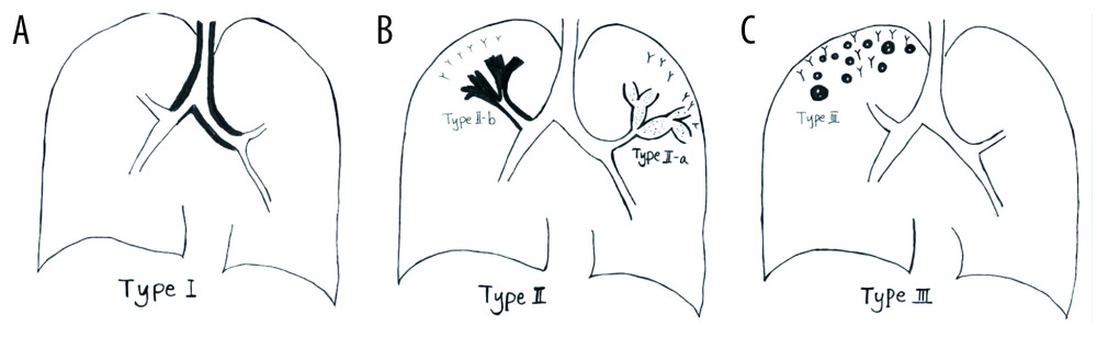 Schematic diagram of different types of airway-invasive pulmonary aspergillosis. (A) Type I: mainly invading the trachea and the main bronchus and the wall of the trachea, and the main bronchus is thickening. (B) Type II mainly involves the lobular and segmental bronchi. In the early stages of type II, only the bronchial wall is thickened. In the late stage of follow-up, type IIa or type IIb can be found. Type IIa is associated with obvious bronchiectasis, and type IIb mainly infiltrates along the periphery of the bronchus without obvious bronchiectasis. (C) Type III involves the bronchioles and pulmonary parenchyma, manifested as peripheral bronchioles and acinar nodules. As the course of the disease progresses, the nodules fuse to form patches of consolidation, with small cavities often appearing inside.