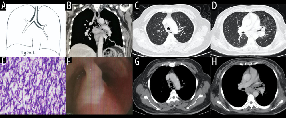 Case 1. A 48-year-old woman had cough and shortness of breath for 1 month, with a past history of diabetes mellitus. (A, B) The coronal view of the mediastinum, indicating major thickening along the left main bronchus, partial stenosis of the lumen, and inflammation of the distal lung tissue, which is similar to the schematic diagram. (C, D) Thickening at the walls of the trachea and left main bronchus in the lung window. (E) Pathological Aspergillus hyphae and small round spores (HE ×400). (F) The trachea and left main bronchus were covered by pus-like exudates via bronchoscopy. (G, H) Thickening of the wall of the bronchus, the soft tissue shadow in the mediastinum (inflammatory infiltration or lymph node enlargement) and extraluminal air, indicating the formation of mediastinitis and bronchial fistula.