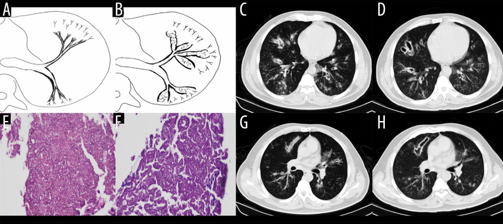 Case 2. A 43-year-old man had cough and shortness of breath for 10 days. (A, B) Schematic diagrams of type II airway-invasive pulmonary aspergillosis, which showed the early stage of type II to type IIa. (C, G) Computed tomography (CT) scan images taken at admission. As shown in the images, there was thickening of the lobar and segmental bronchus, diffuse tree-in-bud sign at the distal end, which was consistent with type II airway-invasion Aspergillus. Images (D) and (H) are CT scan images on the same slice with (C) and (G) after 7 days, showing bronchiectasis, which was consistent with type IIa airway-invasive aspergillosis. Image (E) shows pathological Aspergillus hyphae and small round spores, the hyphae were branched and segmented (HE ×200); (F) (HE ×400).