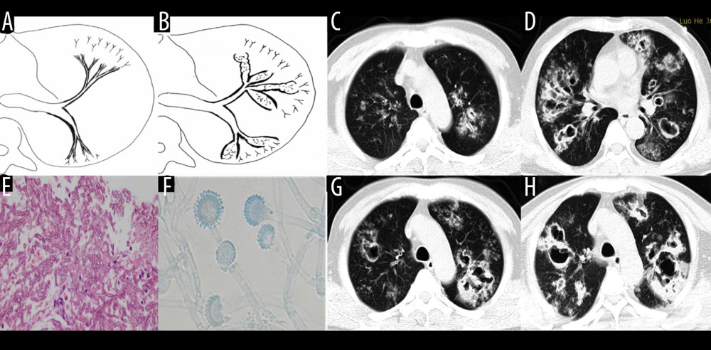 Case 3. A 46-year-old man was hospitalized with fever and shortness of breath for 1 week without a previous significant medical history. (A, B) Schematic diagrams of type II airway-invasive pulmonary aspergillosis, which show early stage of type II to type IIa. (C) Computed tomography (CT) scan image taken at admission, showing only diffuse thickening of the bronchial wall and tree-in-bud signs and acinar nodules at the distal end of the bronchus. (D, G) CT scan images from reexamination after 10 days of antibacterial treatment, which show obvious bronchiectasis. Image (H) was taken on the same slice 5 days later, which showed further bronchiectasis, with internal separation. (E) Shows pathological Aspergillus hyphae and small round spores (HE ×400). Image (F) shows sputum specimens, conidia of Aspergillus fumigatus; Lactophenol cotton blue dyeing, ×1000.