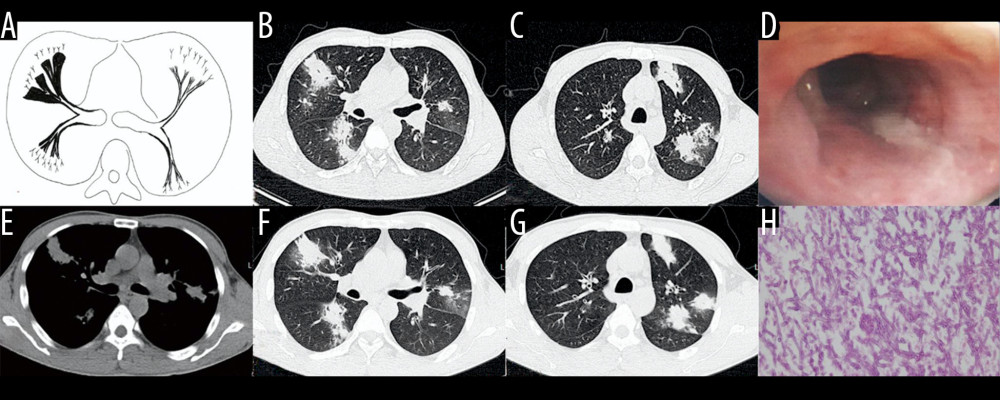 Case 4. A 45-year-old man had cough, sputum, and fever for 2 weeks, accompanied by shortness of breath, and he had been previously in good health. (A) Schematic diagram of type IIb airway-invasive pulmonary aspergillosis. (B, C) Computed tomography (CT) scan images taken at admission, showing both lungs with diffuse lesions distributed along the long axis of the bronchial alignment, with consolidation opacity and stenosis of the bronchus. (B) Arrow shows the location of the pathology. (D) The bronchial wall in the segmental bronchus was covered by pus-like exudates via bronchoscopy. (E) Mediastinal window shows the lesion distributed along the bronchus, and the edge was straight, consistent with the inflammatory changes. (F, G) CT scan images of the lung window on the same slice after 5 days of anti-infective treatment, showing no obvious improvement, diffuse lesions that are distributed along the periphery of the bronchus, and no bronchiectasis. (H) pathological Aspergillus hyphae and small round spores (HE ×400).