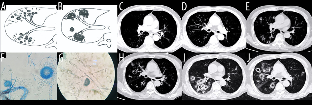 Case 5. An 83-year-old man had chronic obstructive pulmonary disease for more than 20 years had been aggravated for 10 days, with fever of 38°C and shortness of breath. (A, B) Schematic diagram of type III airway-invasive pulmonary aspergillosis, which showed early stage of type III and its progress. (C, D) Computed tomography (CT) scan images on the second day of admission, showing diffuse acinar nodules with punctate cavities in peripheral lungs, with internal separation. (E, H) CT scan images taken on day 5 after admission and reexamination after anti-infective treatment, showing the lung window of the same slice, specifically the lesion and the cavity were further enlarged with compartmentalized changes in the cavity. (I, J) CT scan images taken on the day 8 after admission showing the lung window on the same slice; the lesion was further enlarged, with fusion of small lesions, and the cavity was enlarged and increased, with obvious internal separation. (F, G) Sputum specimens, conidia of Aspergillus flavus; Lactophenol cotton blue dyeing, ×1000.
