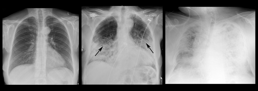 Chest X-ray images of 3 COVID-19-positive patients with different intensity of lung involvement assessed with SARI scoring system. In the left picture both lungs present no radiological signs of parenchymal involvement and were assessed as 1 with SARI scoring system; in the middle picture multifocal consolidations can be spotted and the image was assessed as 4 with SARI scoring system; in the right image nearly entire parenchyma of both lungs present diffuse alveolar changes and the image was assessed as 5 with SARI scoring system.